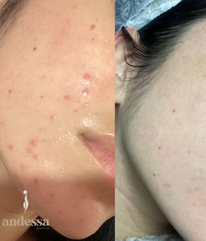 mejorar_acne_paraguay