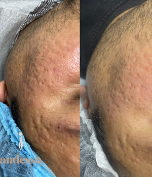tratamiento_acne_asuncion